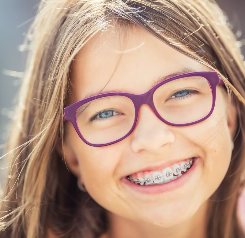 Feste Zahnspange mit modernen Brackets